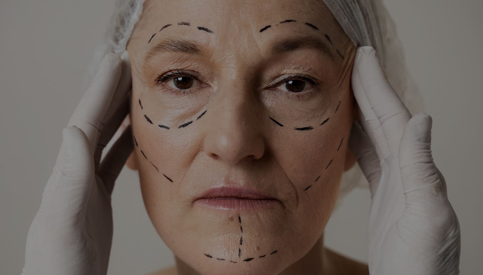 Facelift