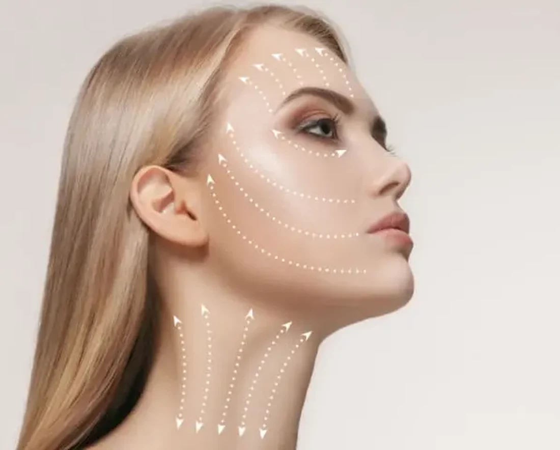 Lift vectors across the cheek, jawline and neck showing the planes treated with a collagen biostimulator at Aeconic Clinic, Canggu, Bali